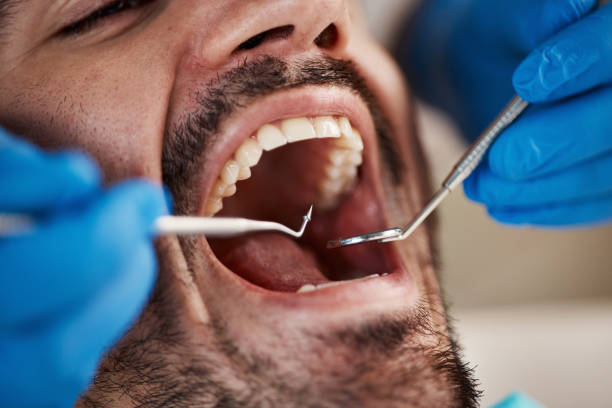Best Broken or Cracked Tooth Emergency Dentist in Cooper City, FL